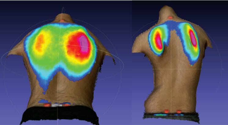 Oxford Metrics Co-founder presents findings of ground-breaking scoliosis research at ScoSym